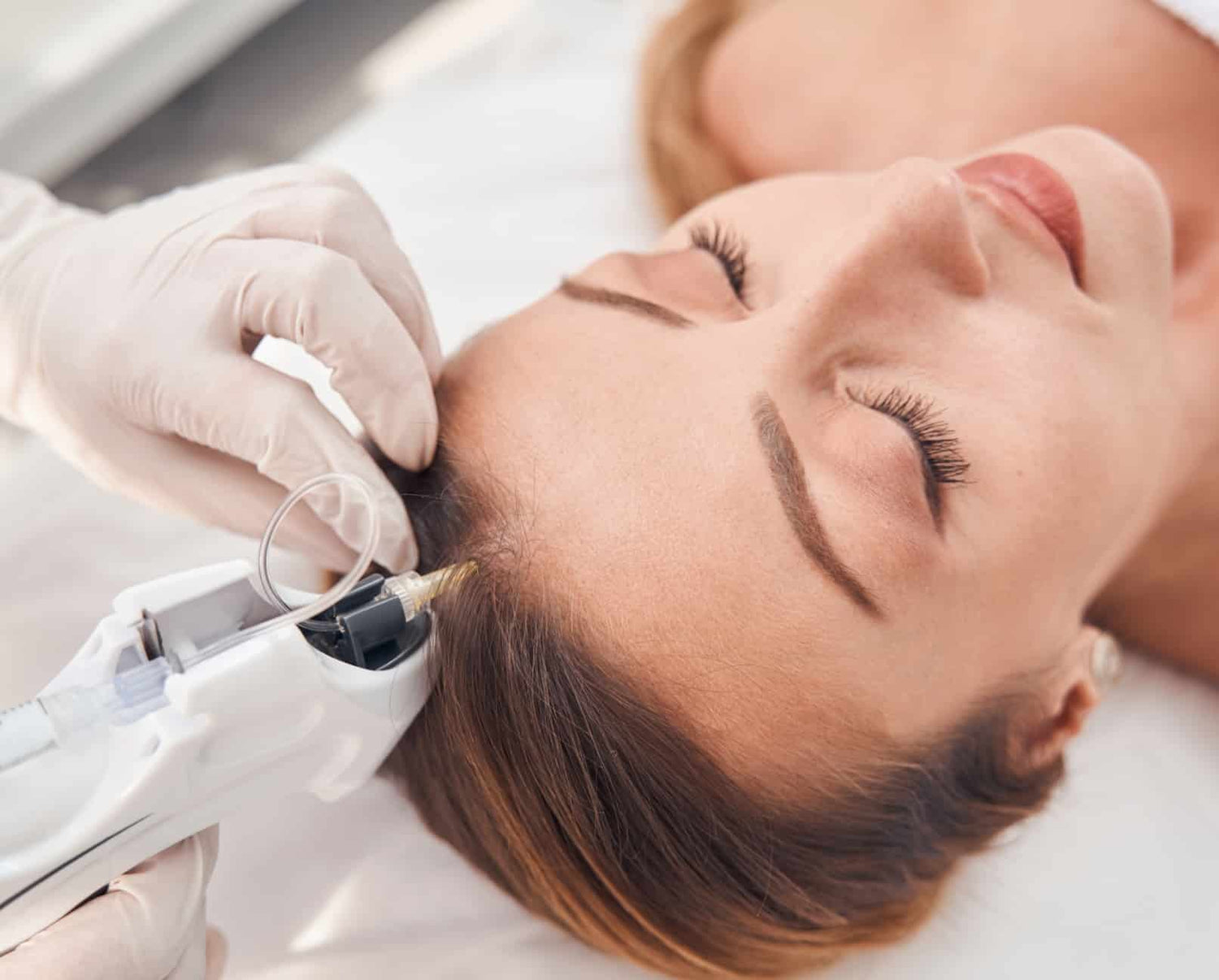 Mesothérapie cheveux