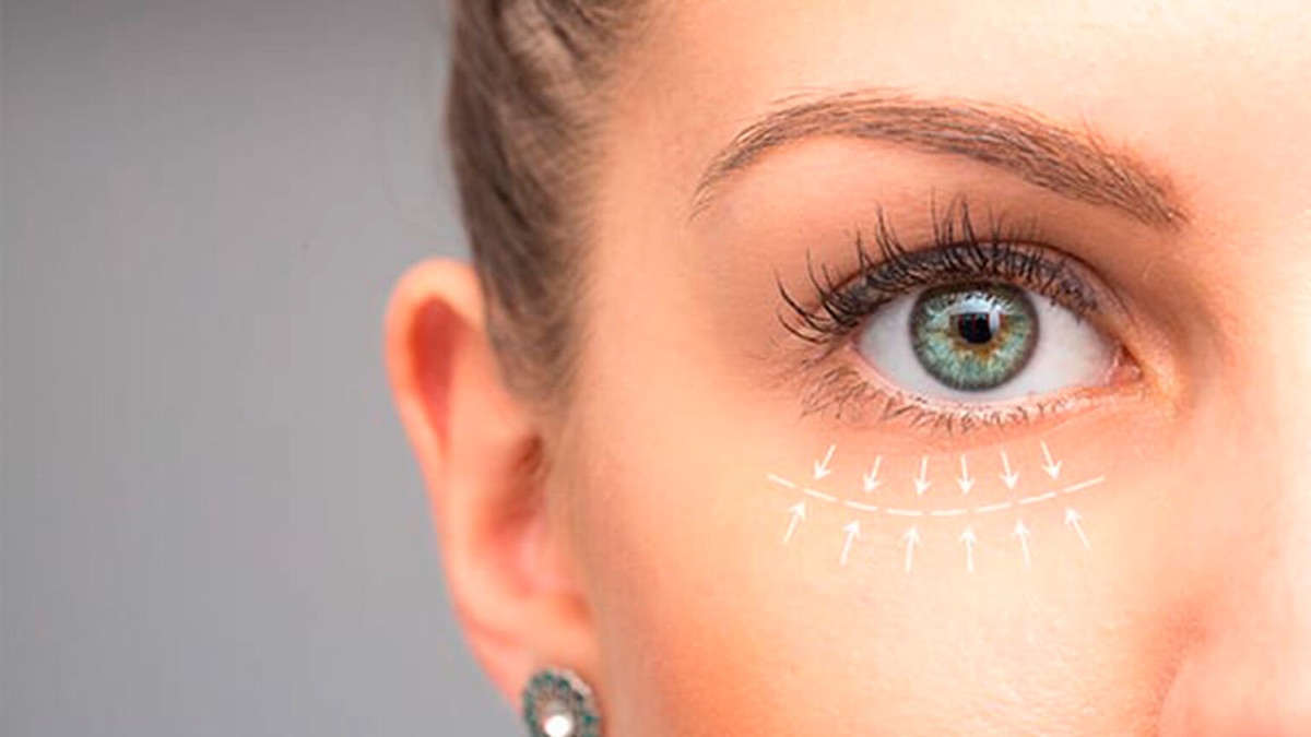 Blépharoplastie paupières inférieures