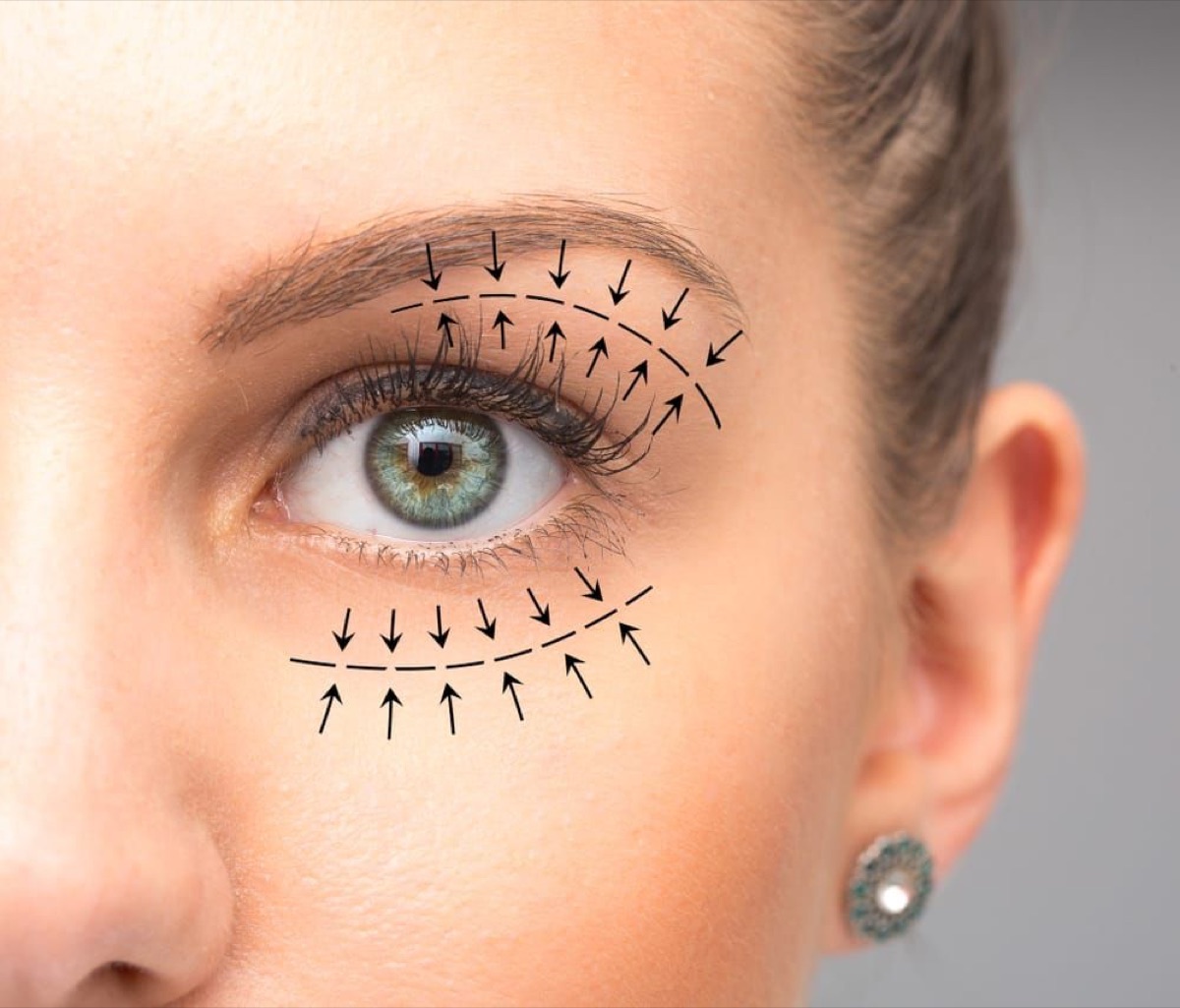 Blépharoplastie paupières supérieures & inférieures