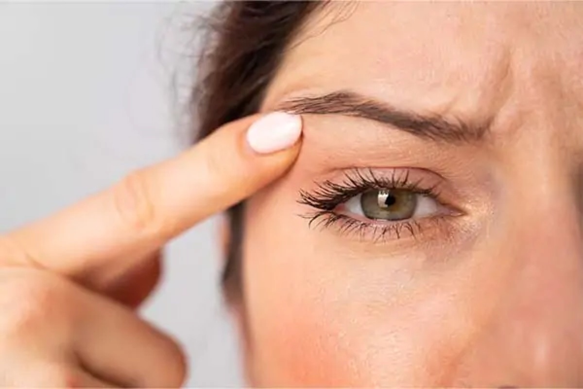 Blépharoplastie paupières supérieures