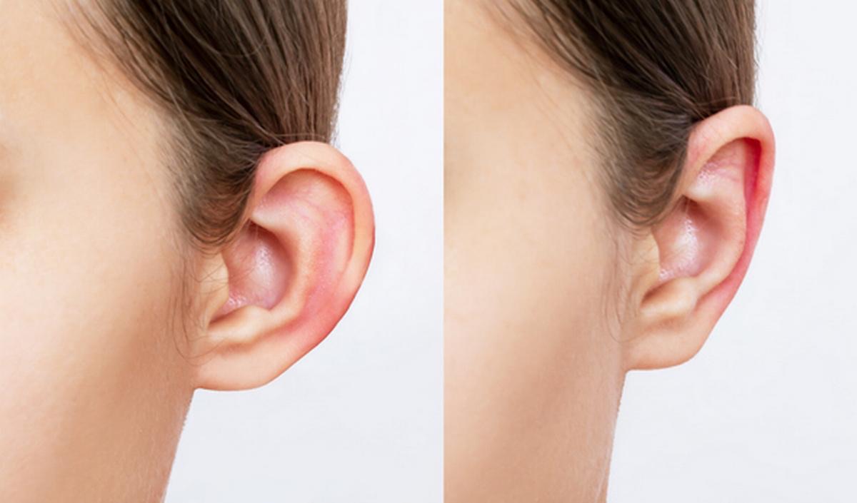 Correction des oreilles — fils Aptos