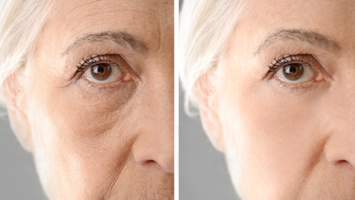 Lifting chirurgical de la partie inférieure du visage