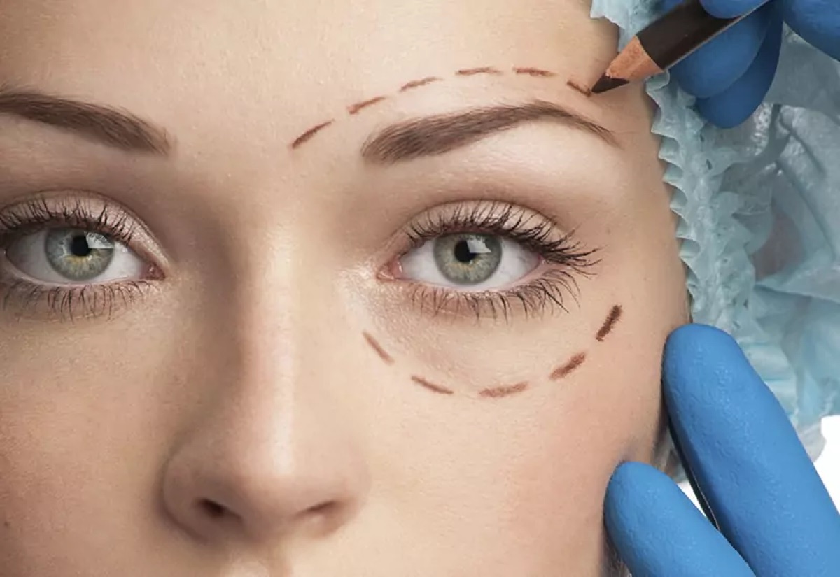 Lifting direct des sourcils