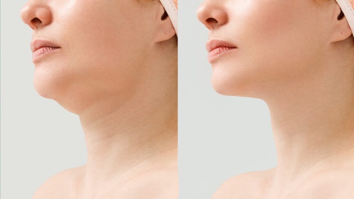 Micro-lipoaspiration du menton & bas des joues