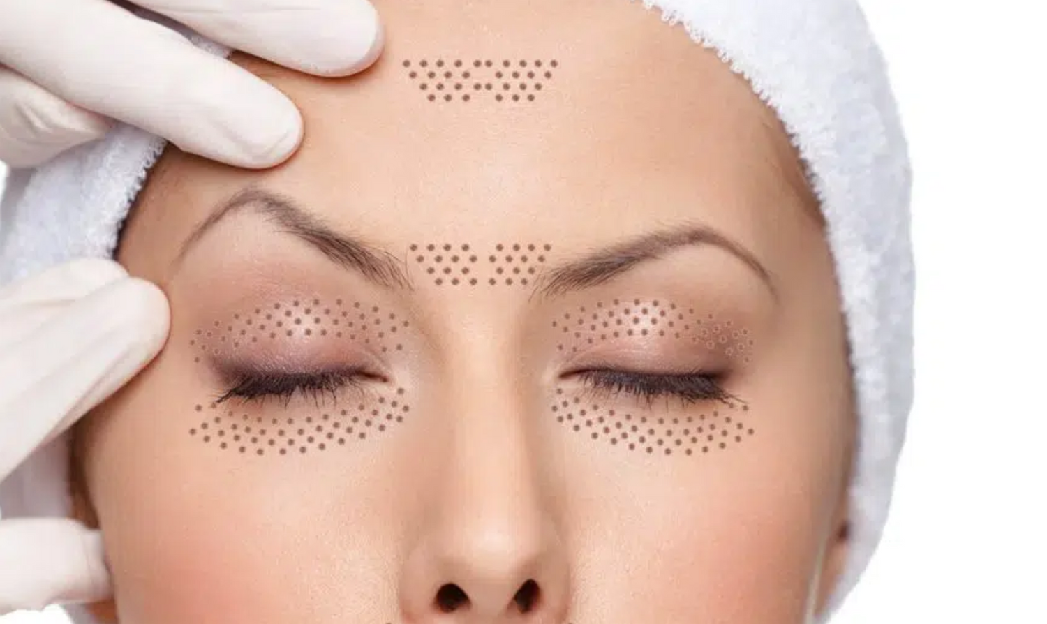 Le plasma-lift soin anti-âge