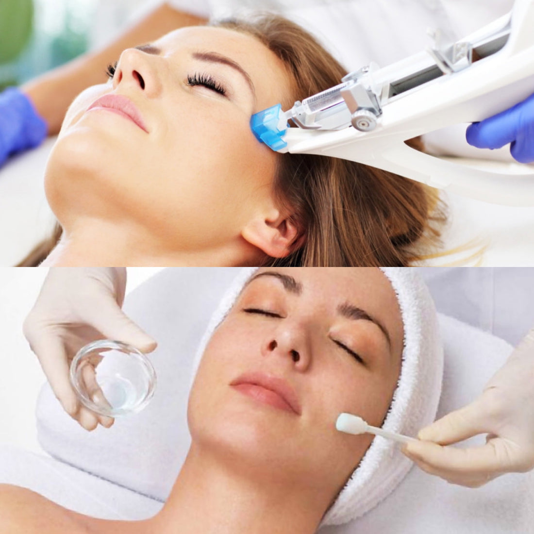 Mésothérapie+Peeling