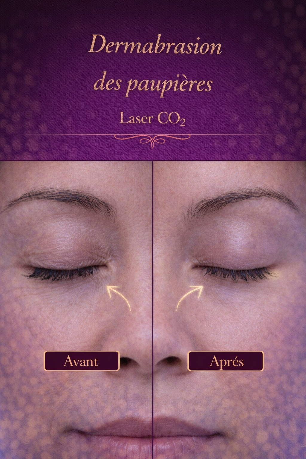 Dermabrasion des paupières au laser CO₂, lissage de la peau et amélioration de la texture des paupières